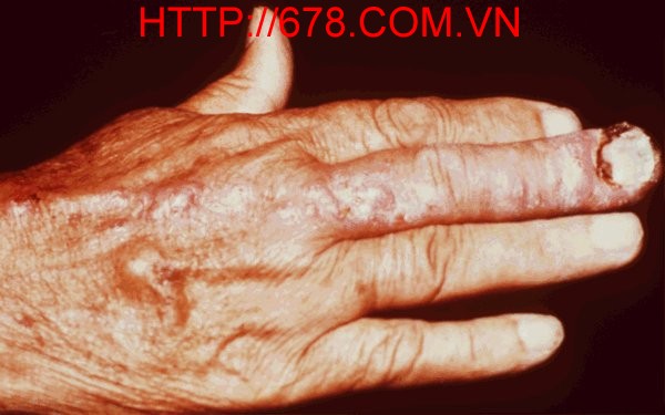 Bệnh nấm Sporotrichum vùng da và bạch huyết